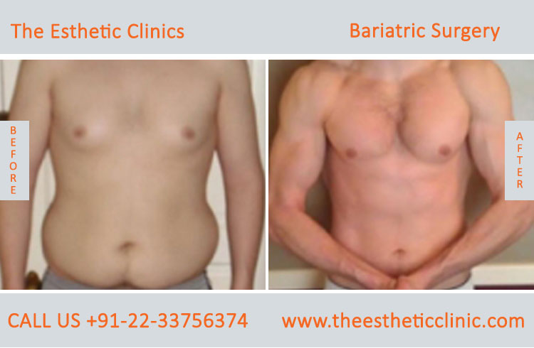 Bariatric Surgery, Weight Loss Surgery before after photos in mumbai india (2)